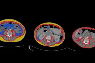 Unlocking the Secrets of Pancreatic Cancer: How Body Composition and Metabolism Hold the Key to Early Detection