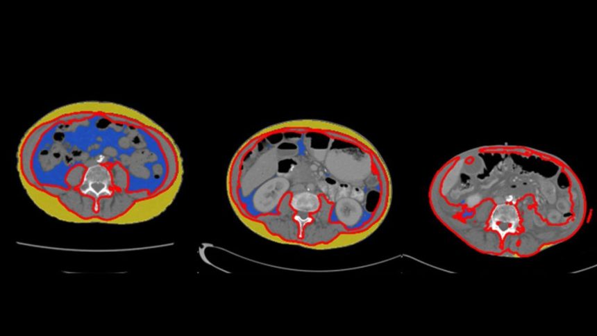 Unlocking the Secrets of Pancreatic Cancer: How Body Composition and Metabolism Hold the Key to Early Detection