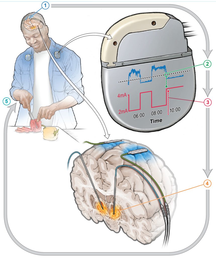 Revolutionary Self-Adjusting Brain Pacemaker Holds Promise for Easing Parkinson’s Disease Symptoms!