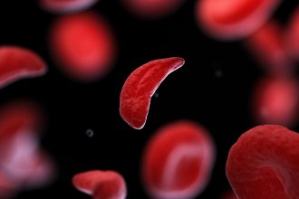 Revolutionary ‘Low-Intensity’ Blood Stem Cell Transplants Show Promise for Lung Health in Sickle Cell Patients!