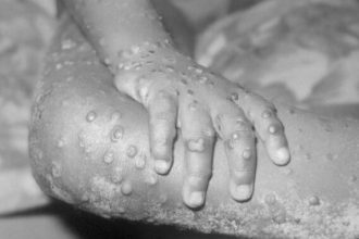 Growing Mpox Outbreak Sparks Urgent WHO Discussions on Global Emergency Declaration