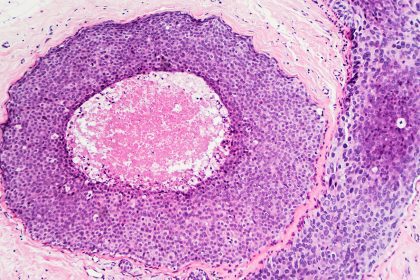 Understanding ‘Stage 0’ Breast Cancer: What You Need to Know About This Early-Stage Diagnosis and Its Treatment Options!