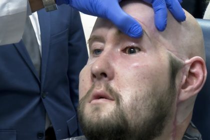 Revolutionary Face Transplant with Eye Integration Celebrates One Year of Success Without Rejection!