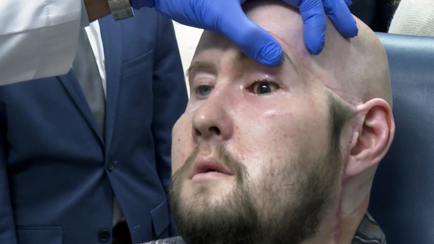 Revolutionary Face Transplant with Eye Integration Celebrates One Year of Success Without Rejection!