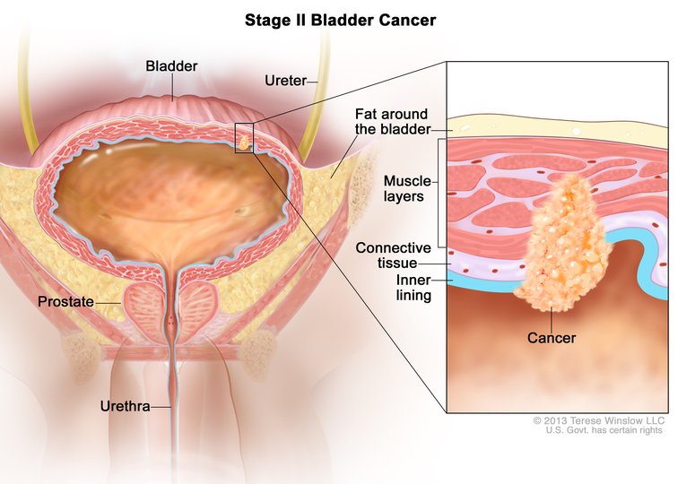 Unlocking Hope: How Immunotherapy After Surgery is Transforming Lives for High-Risk Bladder Cancer Patients