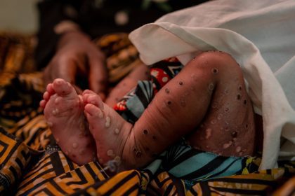 Global Health Initiative Launched: WHO and Partners Unveil Game-Changing Access Plan for Mpox Vaccines, Treatments, and Tests!