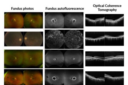 Breakthrough Discovery: Scientists Uncover Gene Behind Rare Inherited Eye Disease!